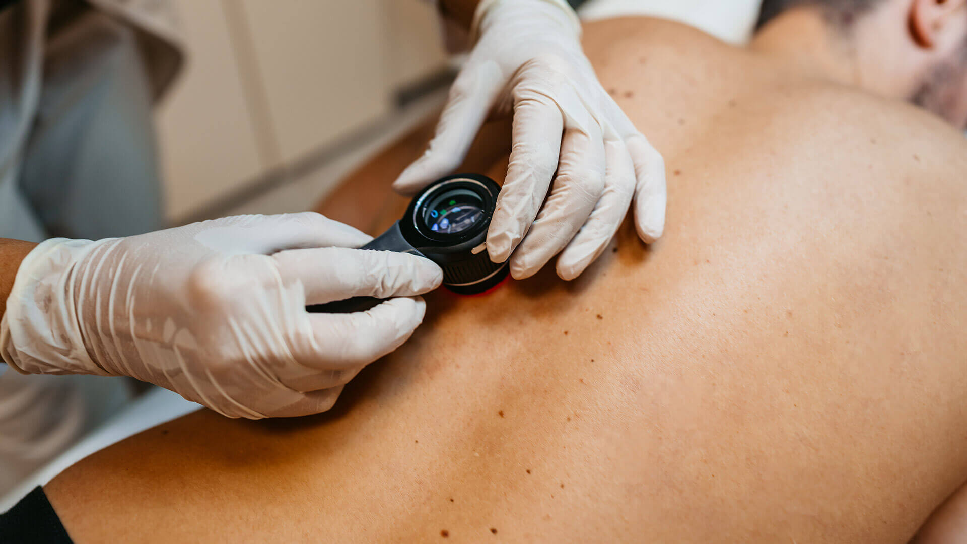 Melanoma: What It Is, Causes, Symptoms, and Treatment