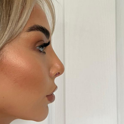 Pall Mall | Amelia Goodman after Nose Job 