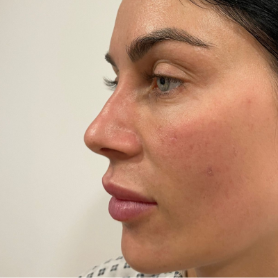 Pall Mall | Cally Beech before Nose Job 