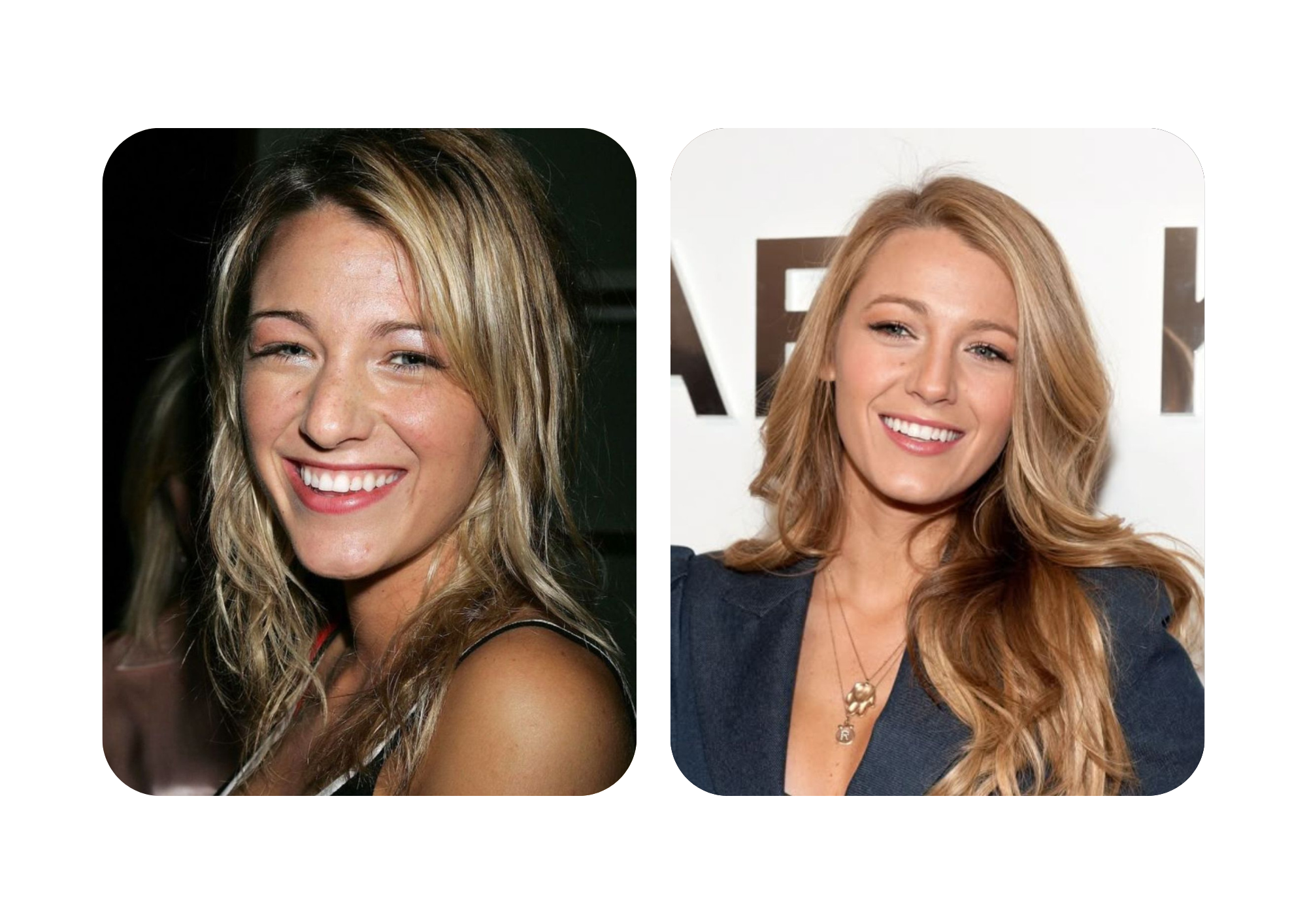 Blake Lively nose job before and after pics 