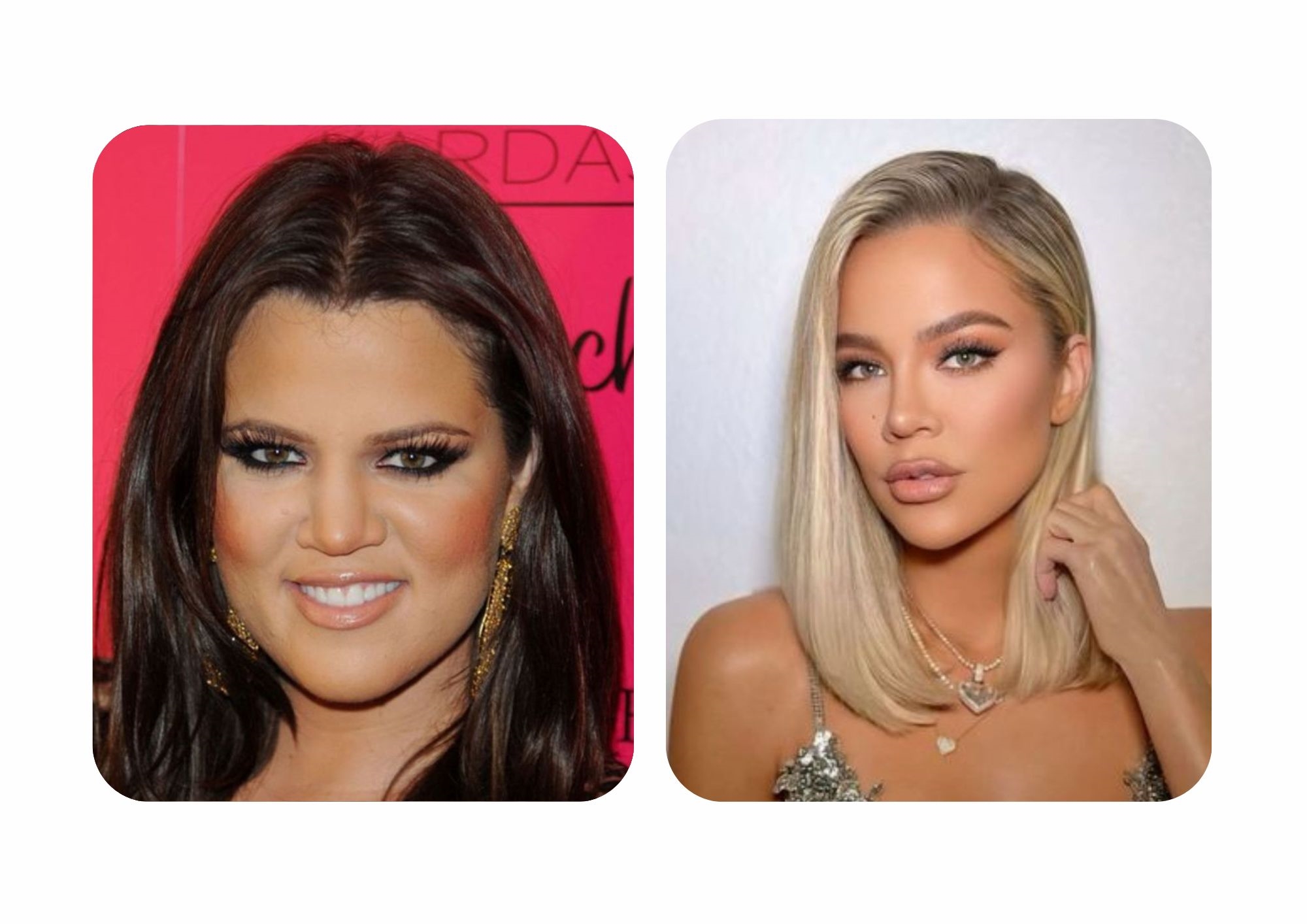 Khloe Kardashian: before and after nose surgery