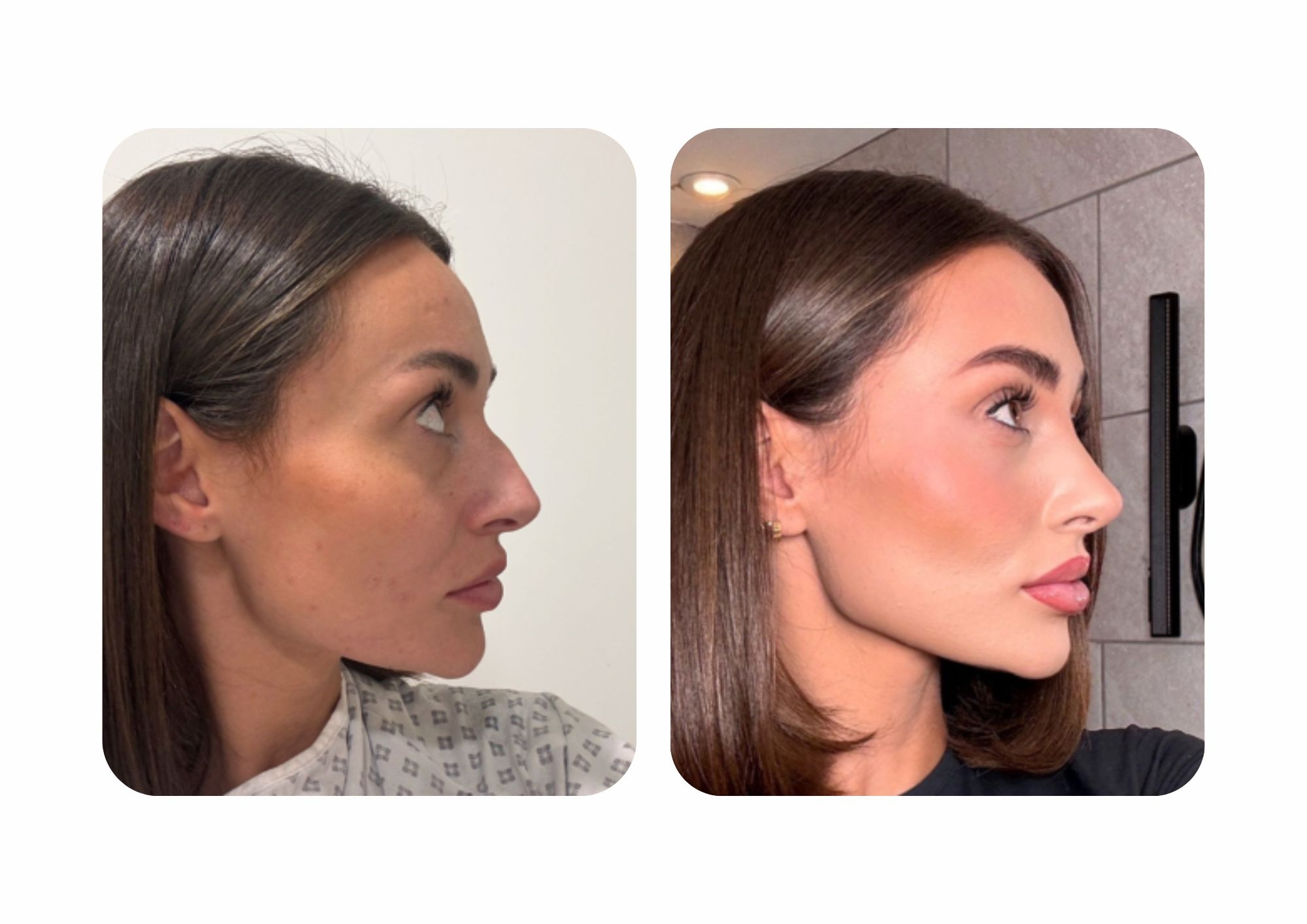 Nose job before and after