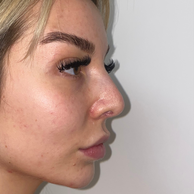 Pall Mall | Amelia Goodman before Nose Job 