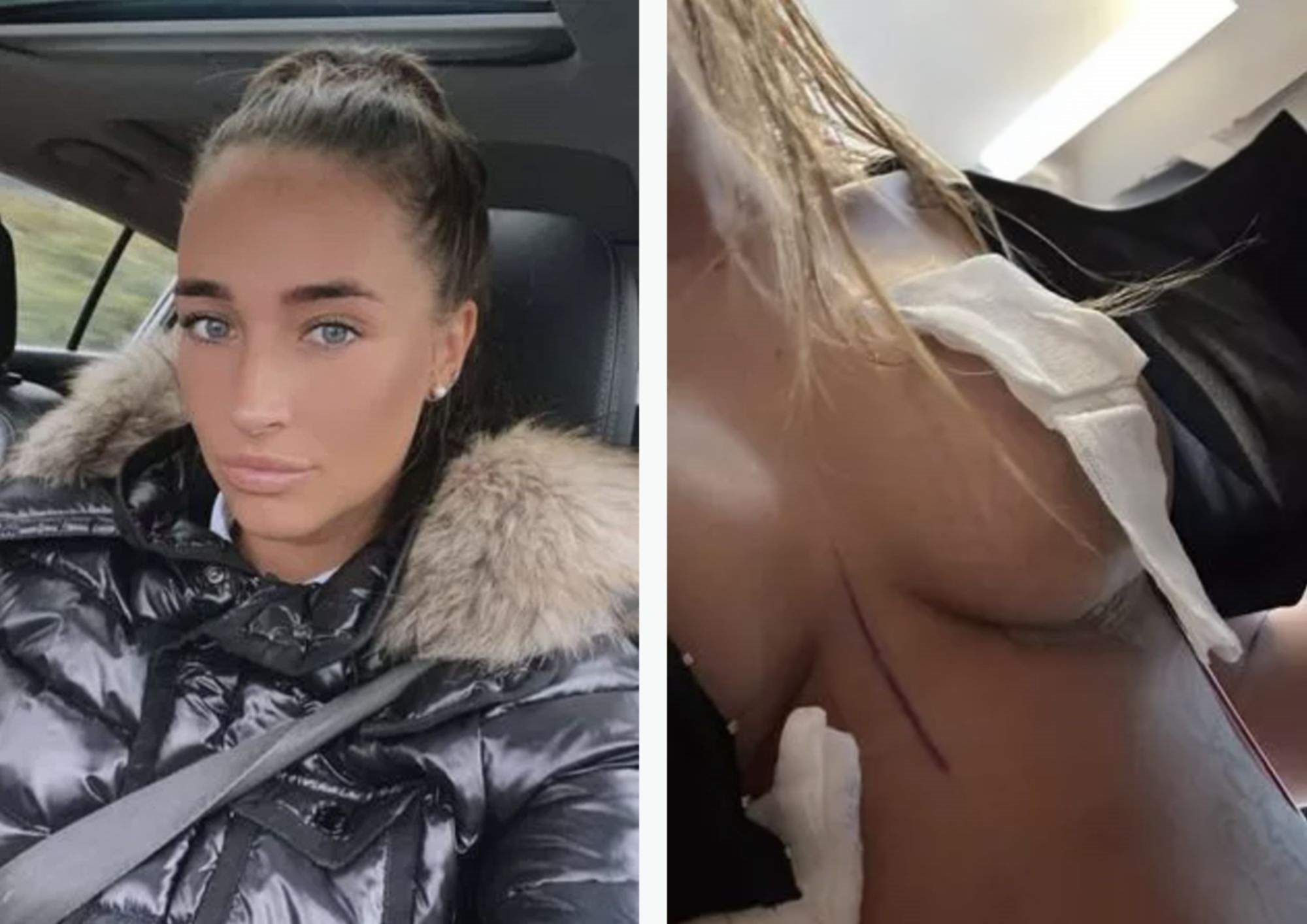 I was left with wonky nipples after ‘botched’ Turkey boob job