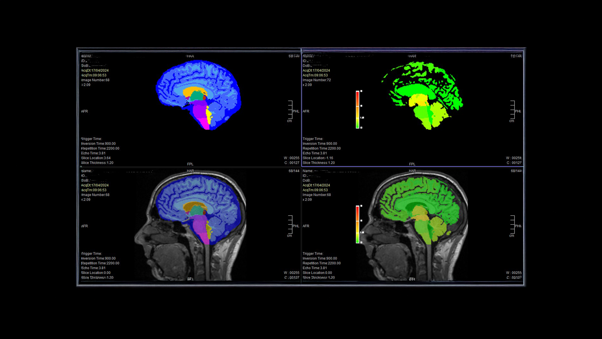 Joaquim Chaves Saúde implements AI algorithm to optimise neurological diagnoses