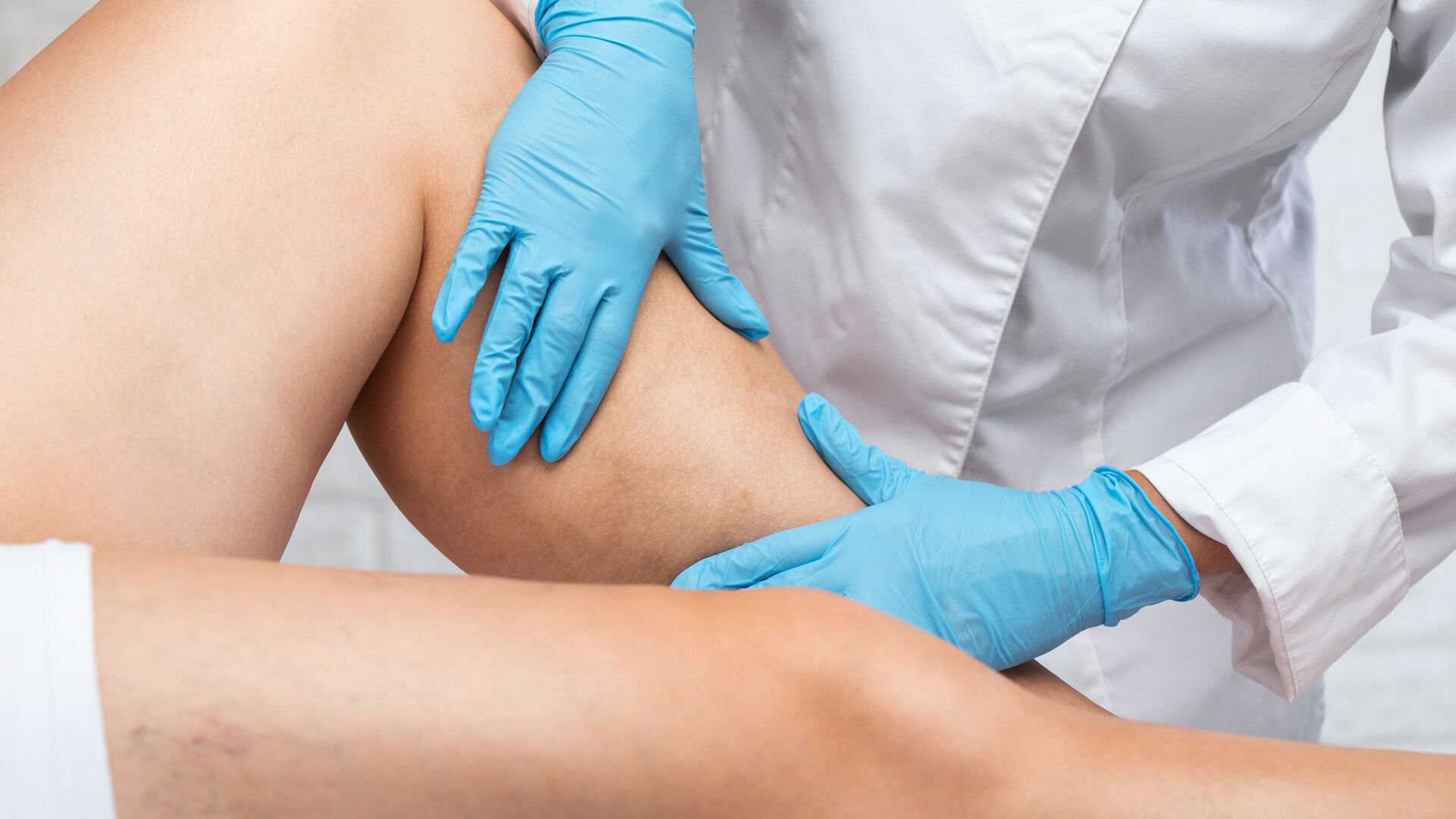 a physician analyses varicose veins in a patient’s legs for removal and treatment
