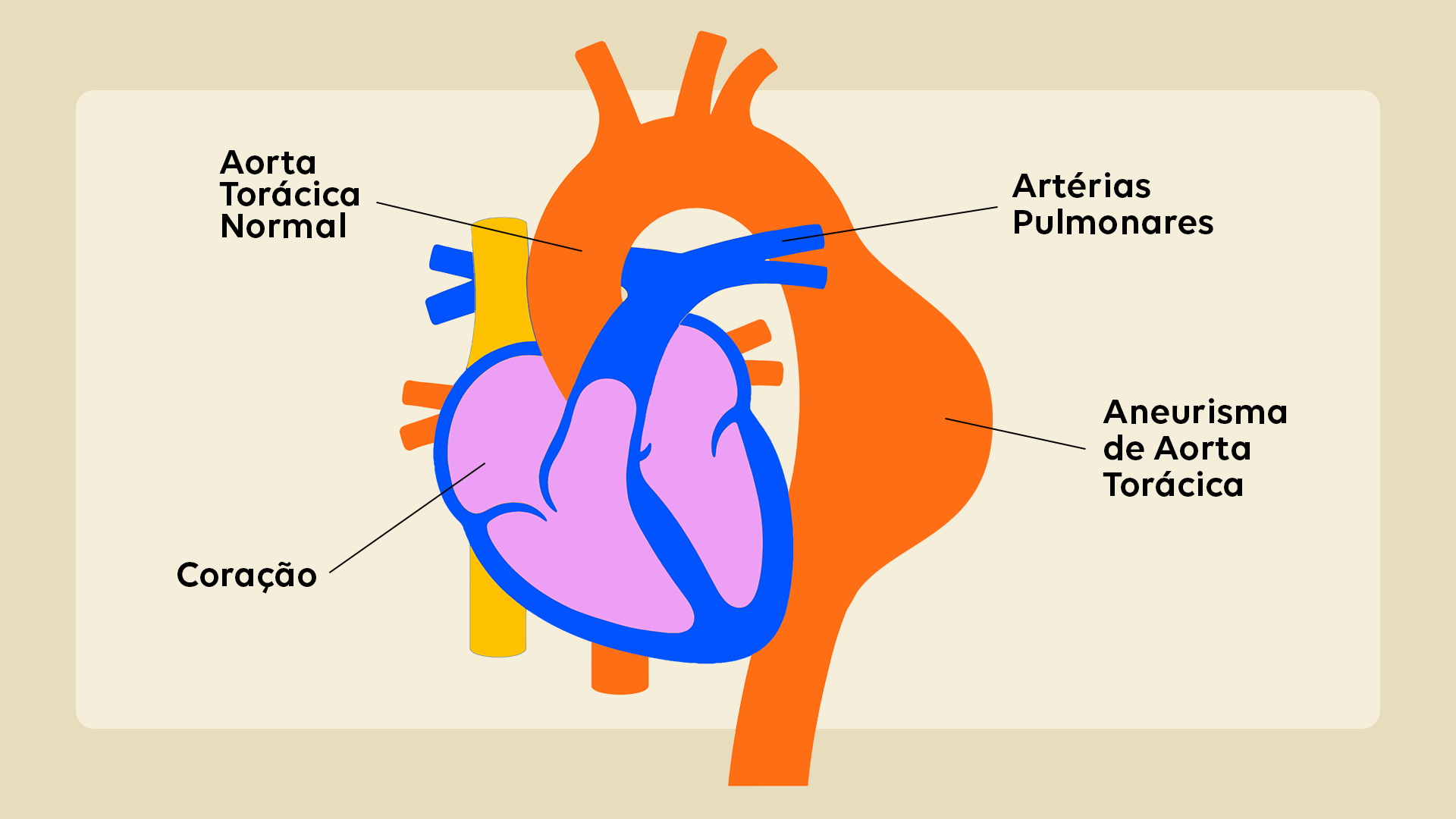 Aneurisma da aorta: o que é, causas, sintomas e tratamento| JCS