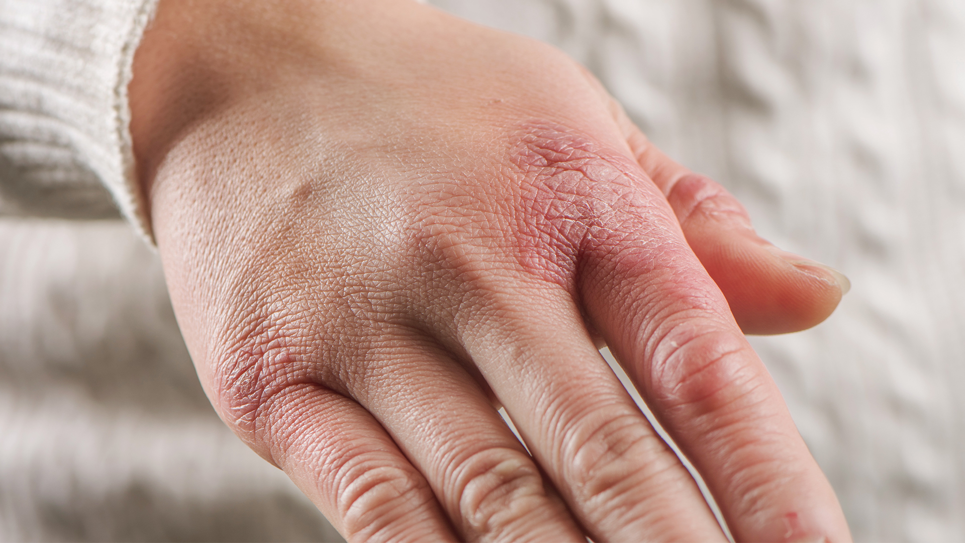 Chilblains: what they are, prevention and treatment