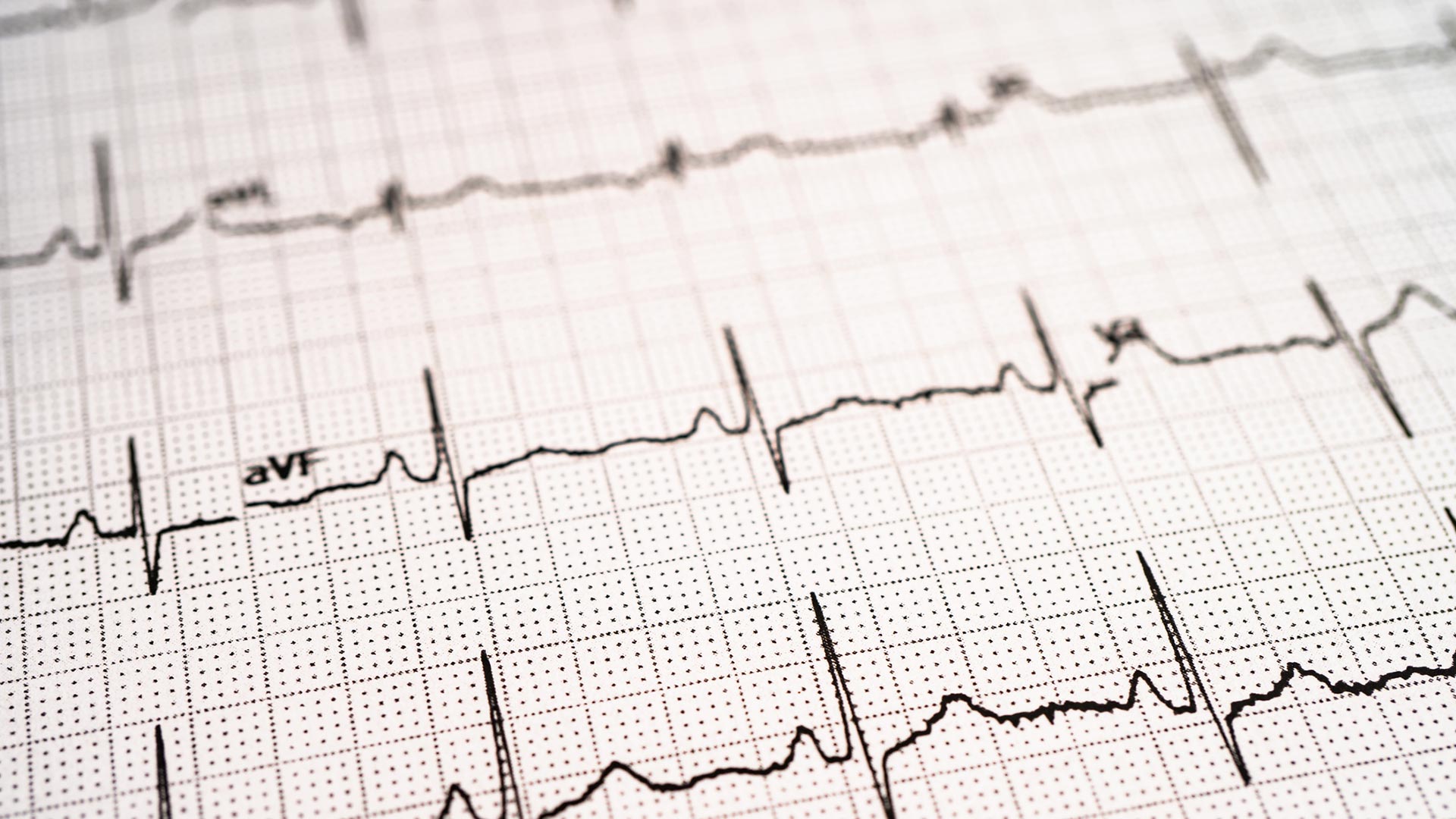 Electrocardiogram: how it’s done and how to prepare 