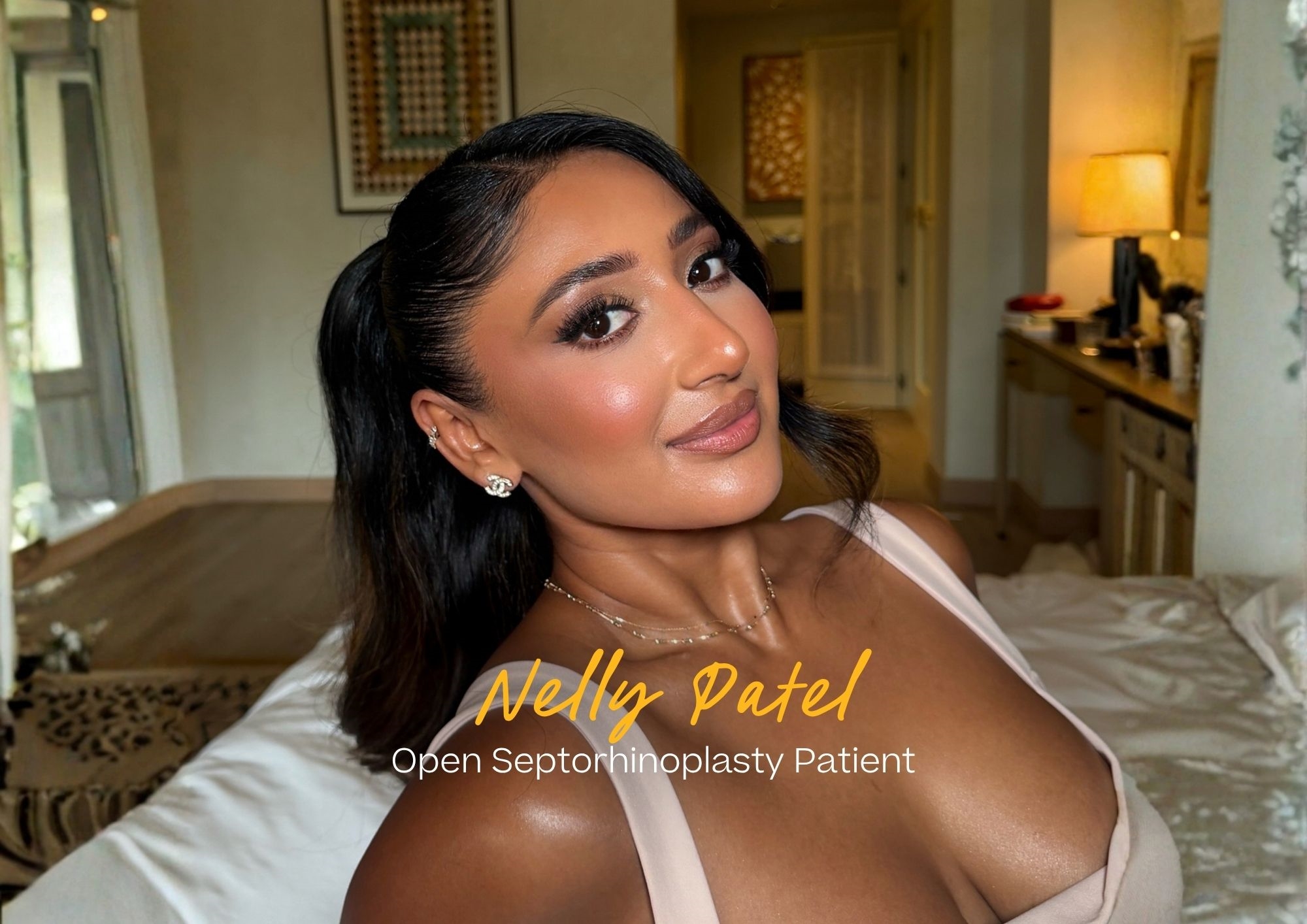 Nelly Patel Open Septorhinoplasty patient Nelly Patel Open Septorhinoplasty patient