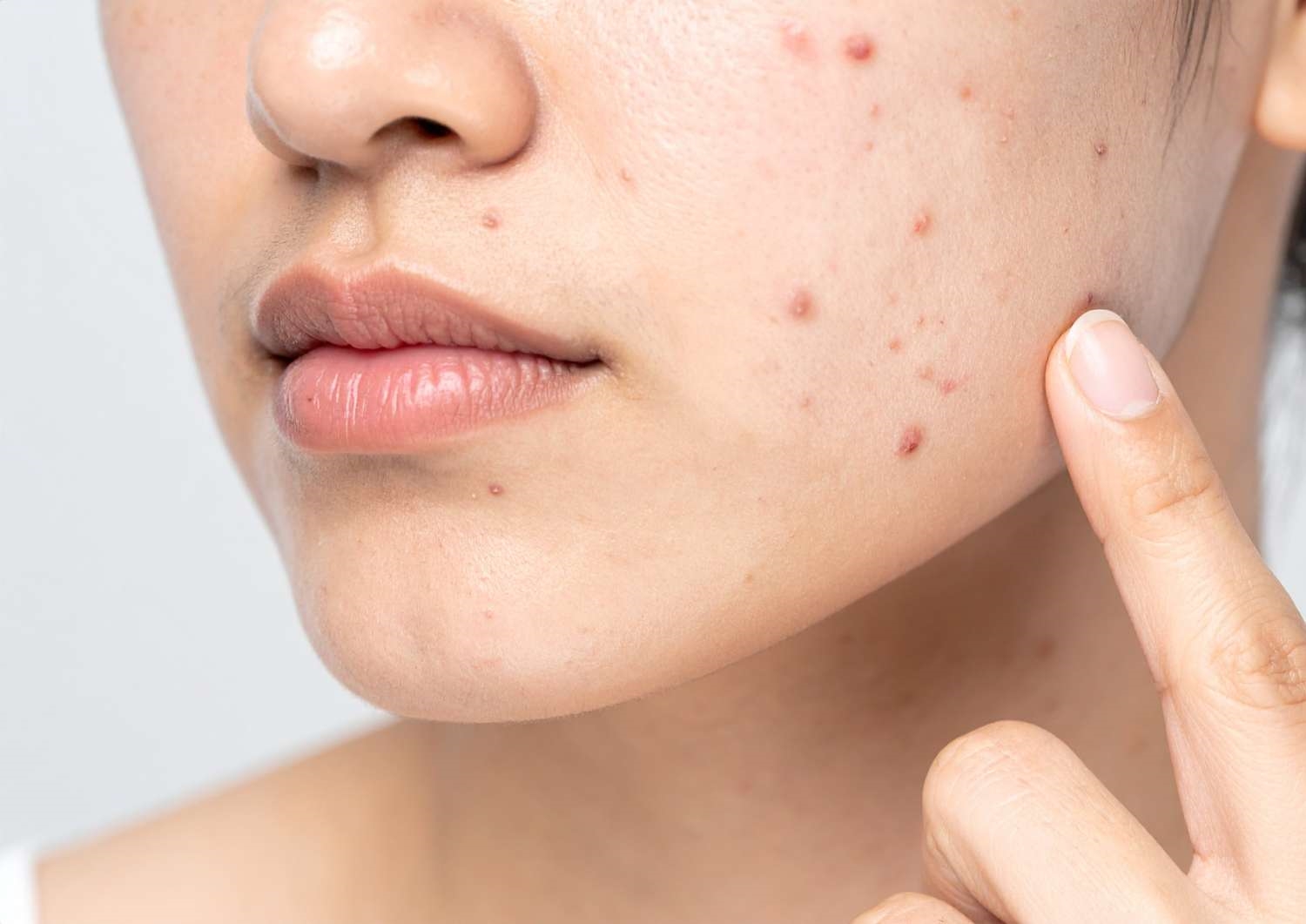 Acne scarring treatment