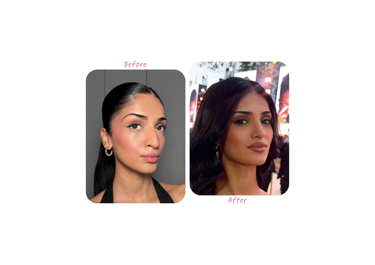 Kim Mann Before & After Rhinoplasty Results