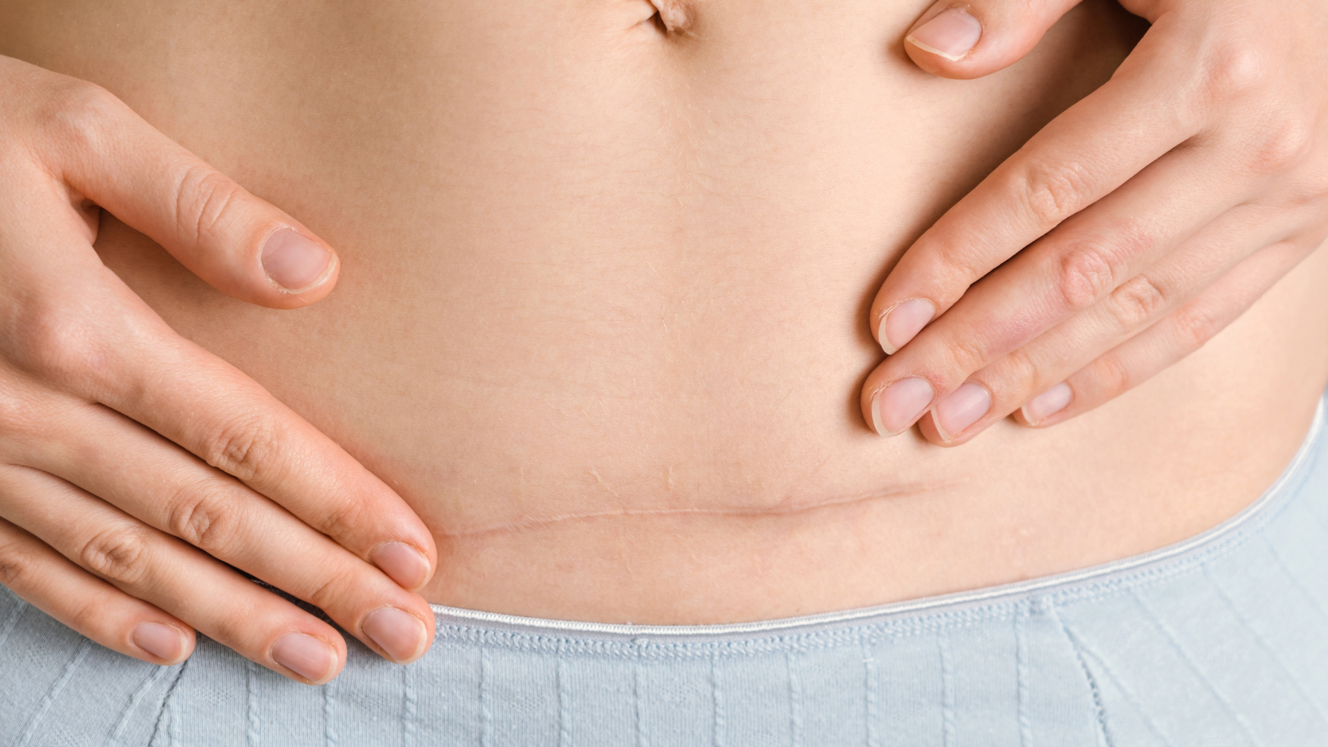 Tummy Tuck scars: What to expect