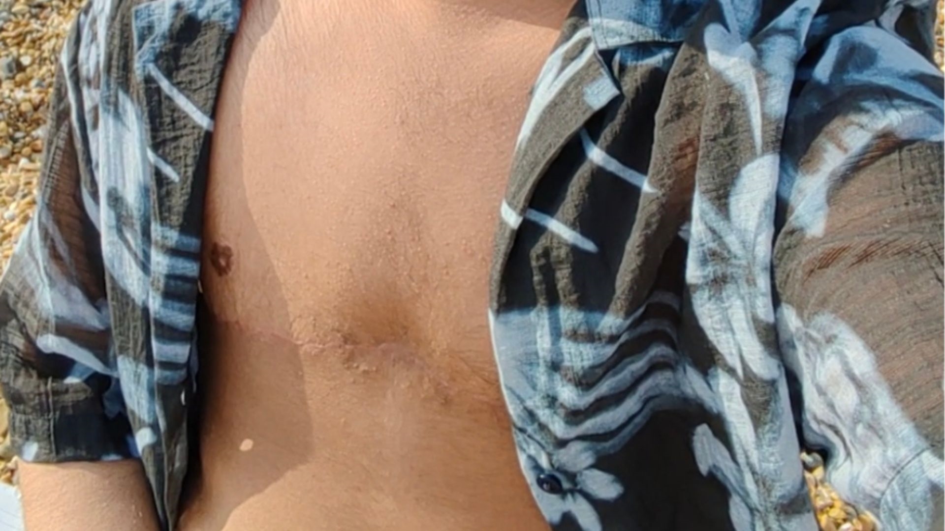 Top surgery FTM patient Top surgery FTM patient