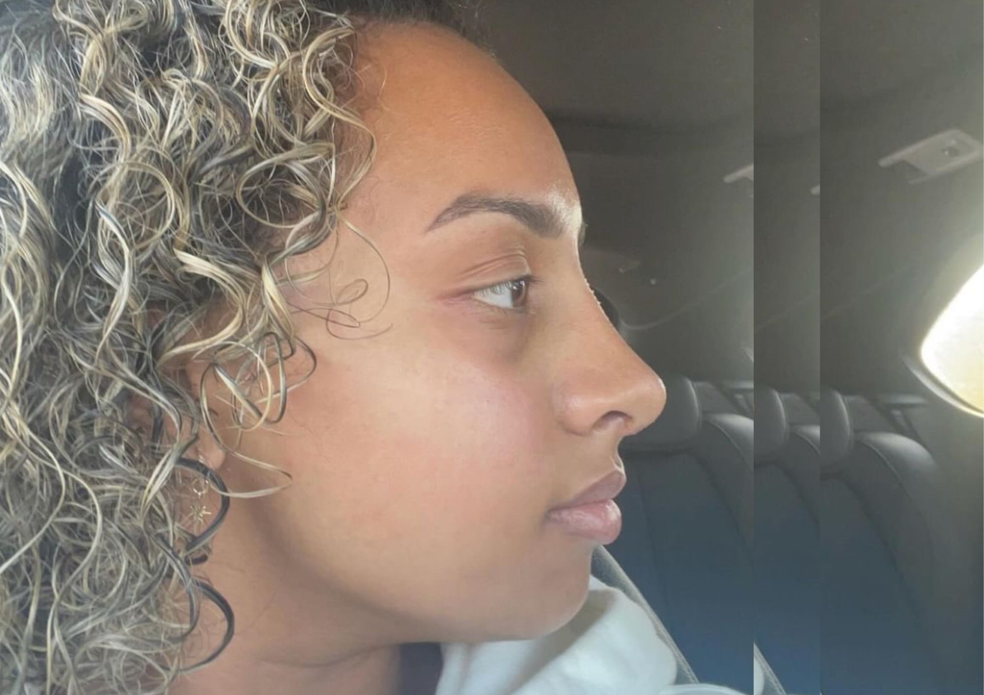 Bev's nose after Rhinoplasty at Pall Mall