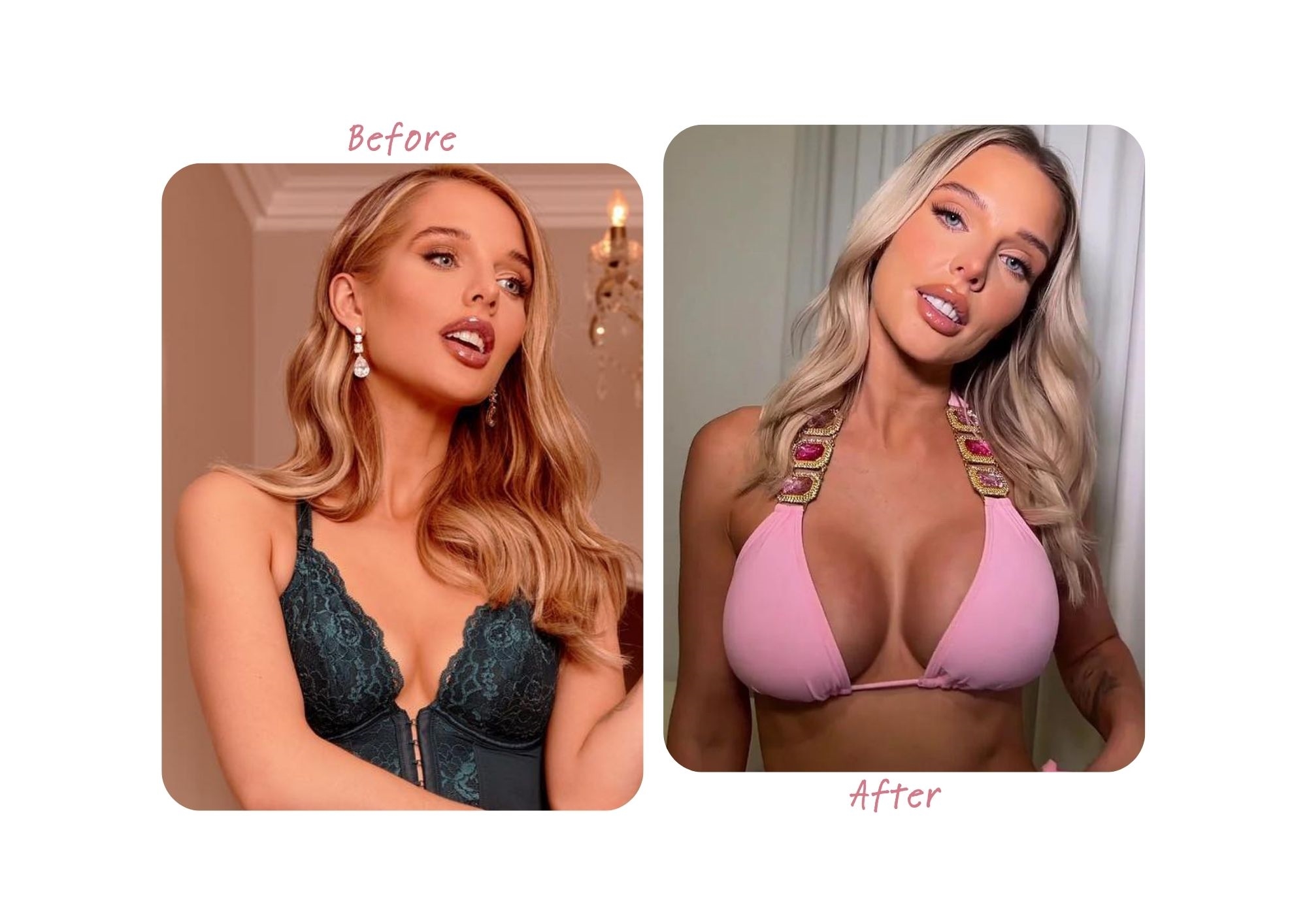 Helen Flanagan before and after breast enlargement Helen Flanagan before and after breast enlargement