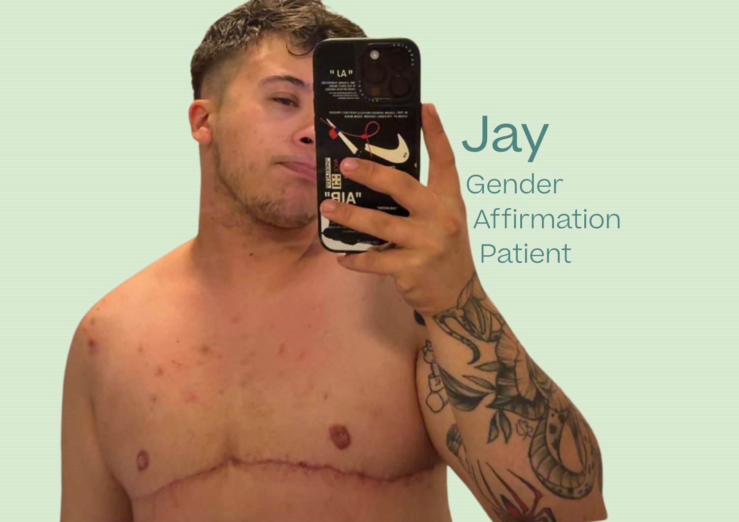 What is it like to have Top Surgery