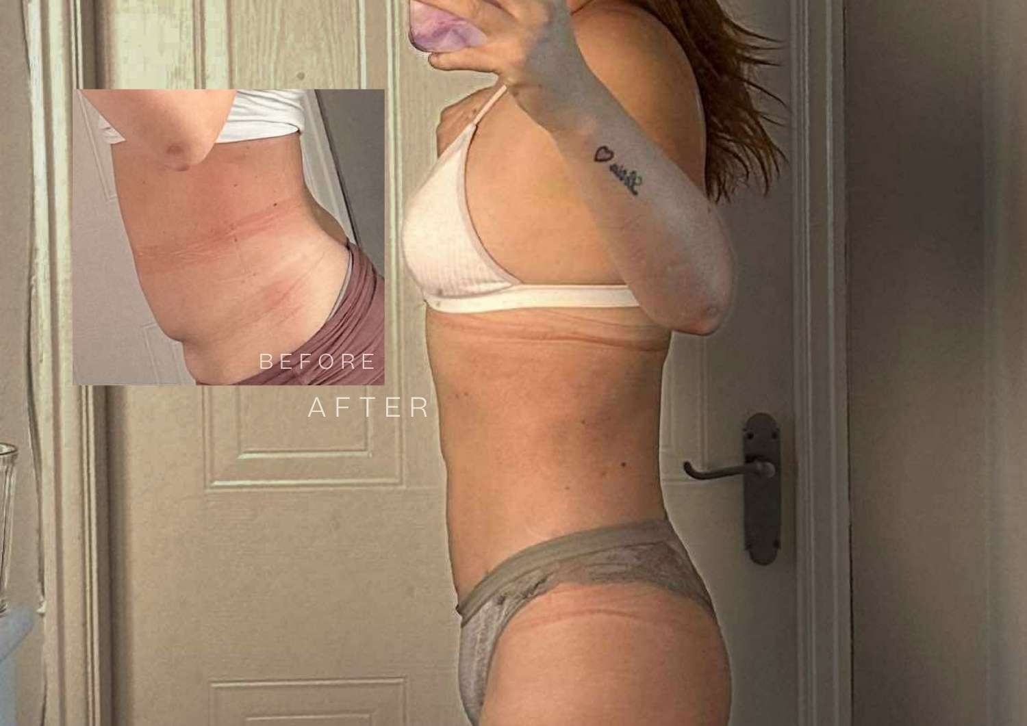 Vaser Liposuction patient Before & After Vaser Liposuction patient Before & After