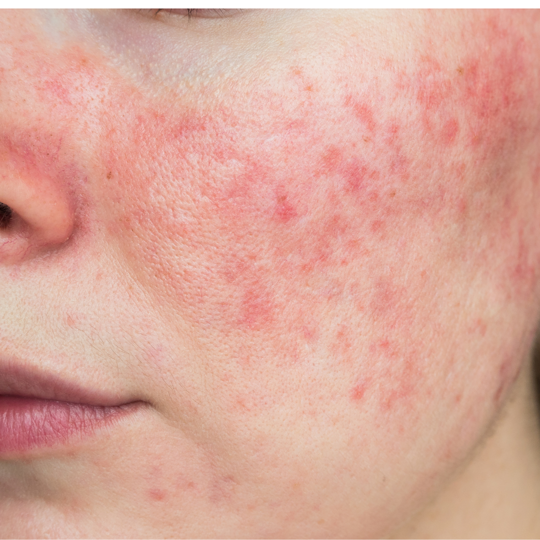 Tired of Hiding Redness? Expert Steps to Calm Rosacea for Good