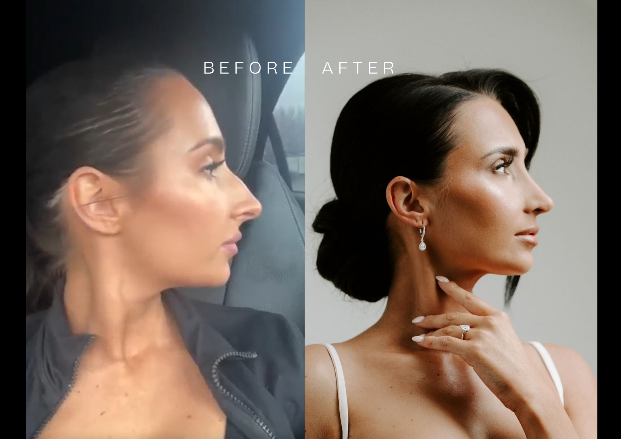 Open rhinoplasty before and after Open rhinoplasty before and after