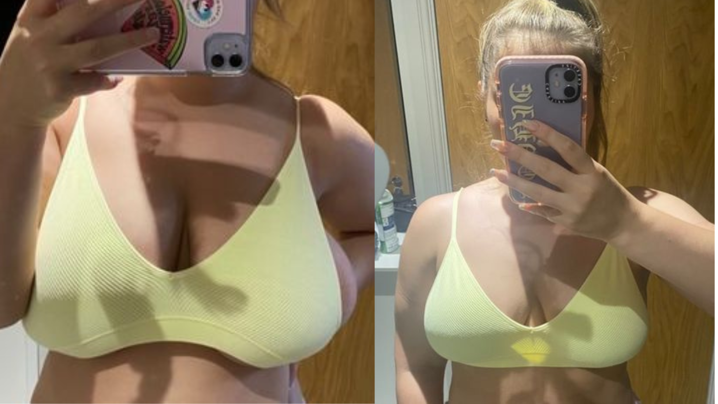 Breast Reduction Before and After Pictures Case 93