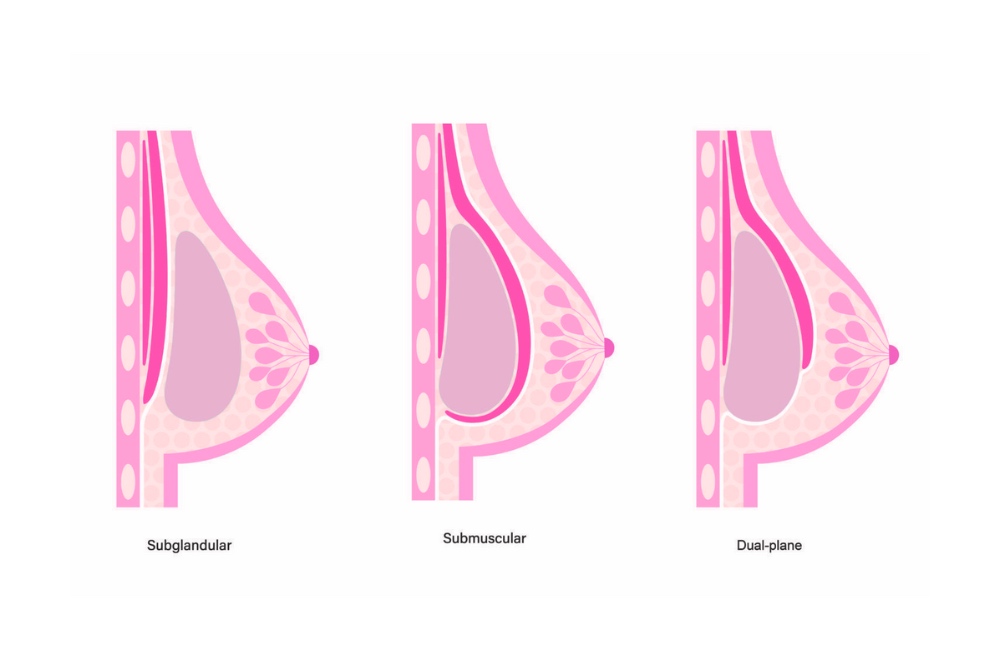 breast implant placement diagram