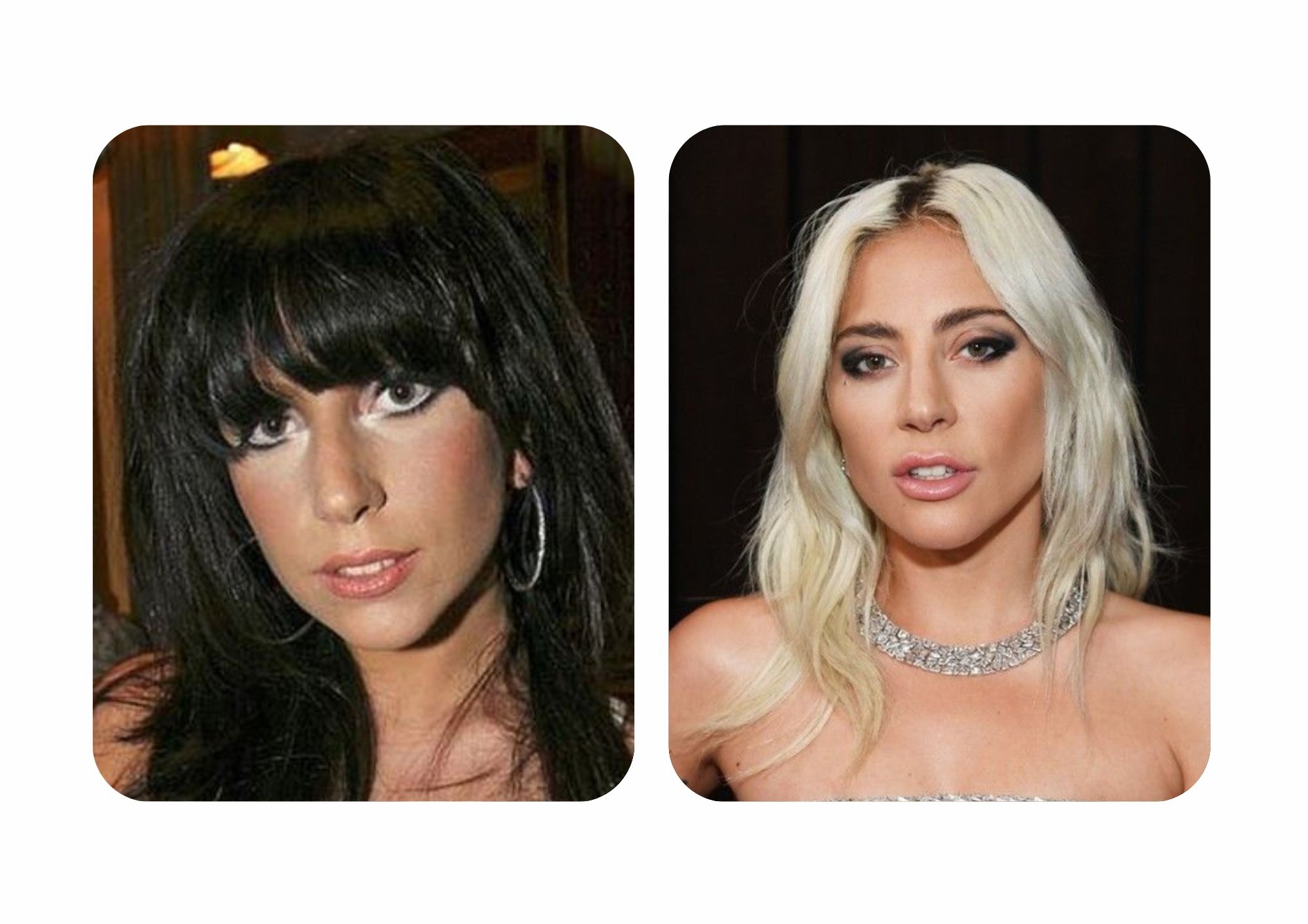 Lady Gaga before and after nose surgery 