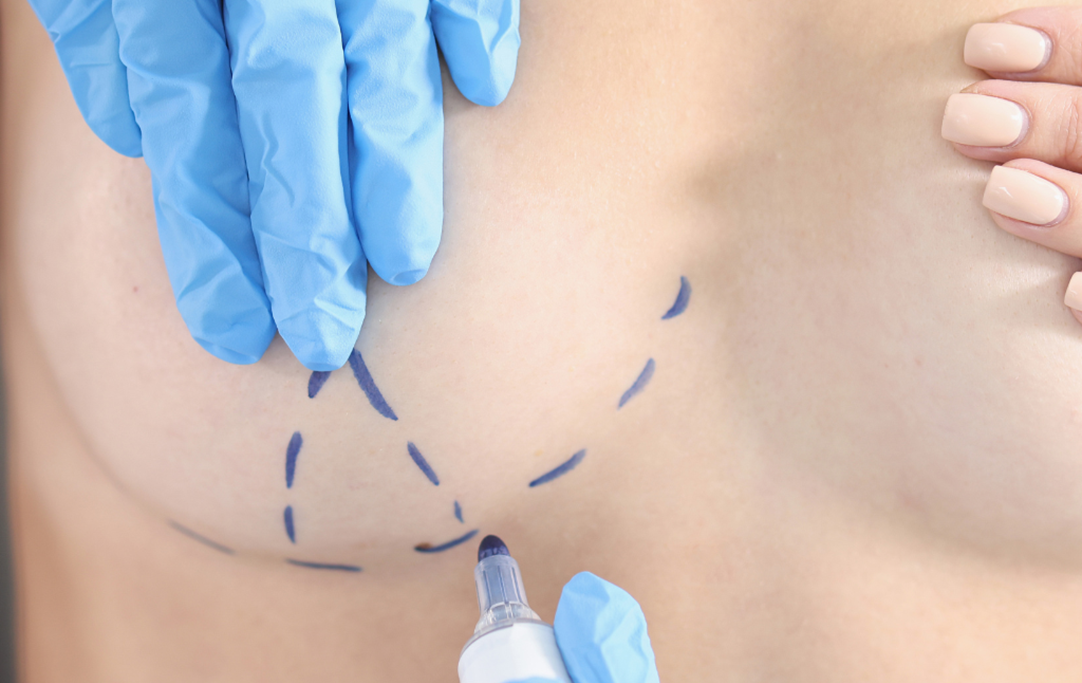 Breast Reduction Surgery Gaining in Popularity