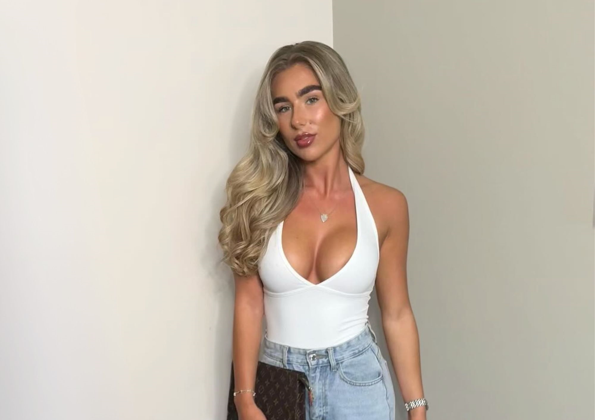 After breast augmentation 400cc, dual plane placement After breast augmentation 400cc, dual plane placement