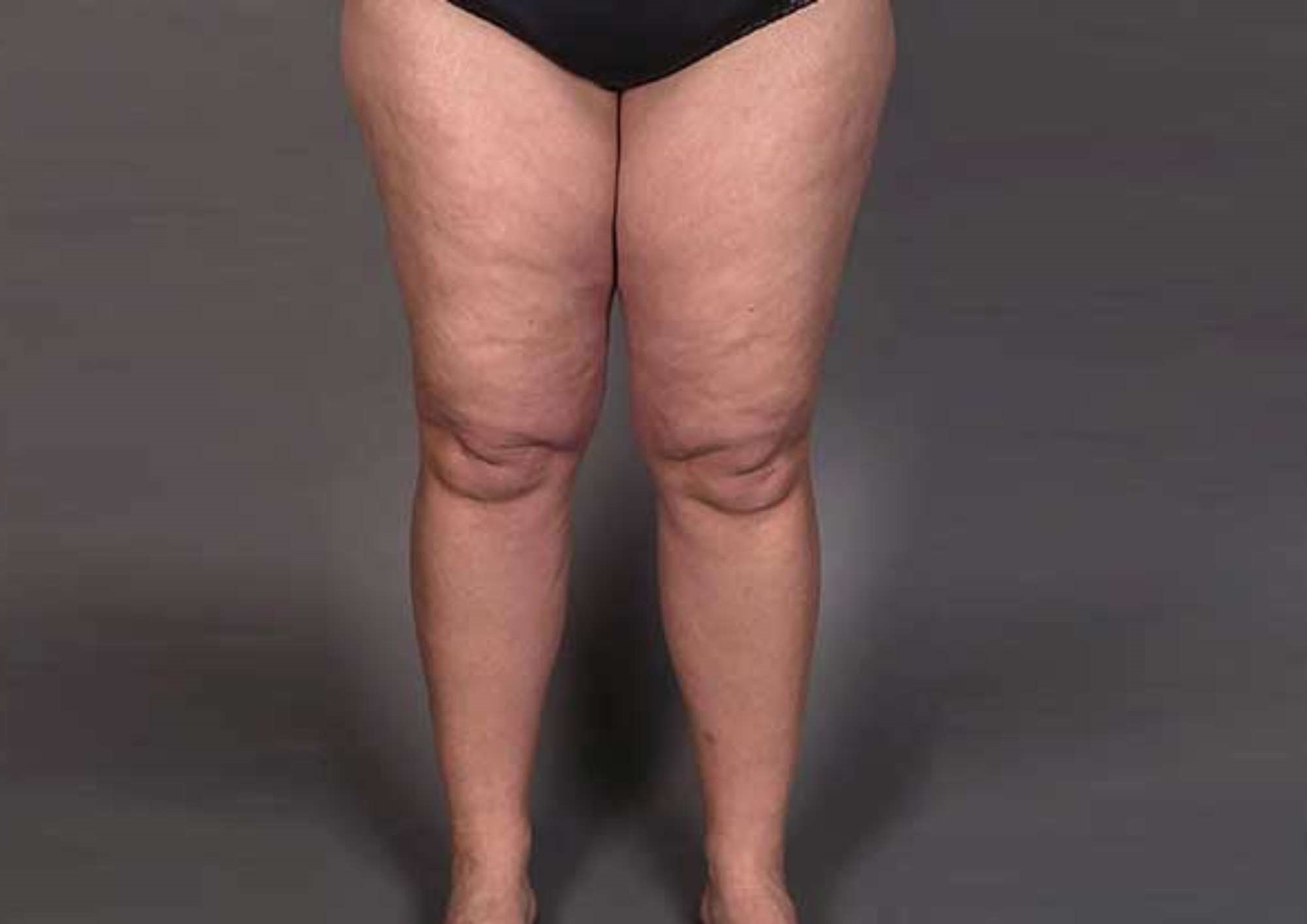 Can VASER Liposuction Help Treat Lipoedema?