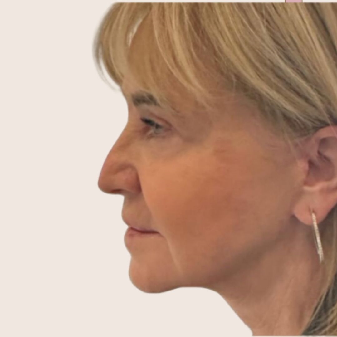 After necklift