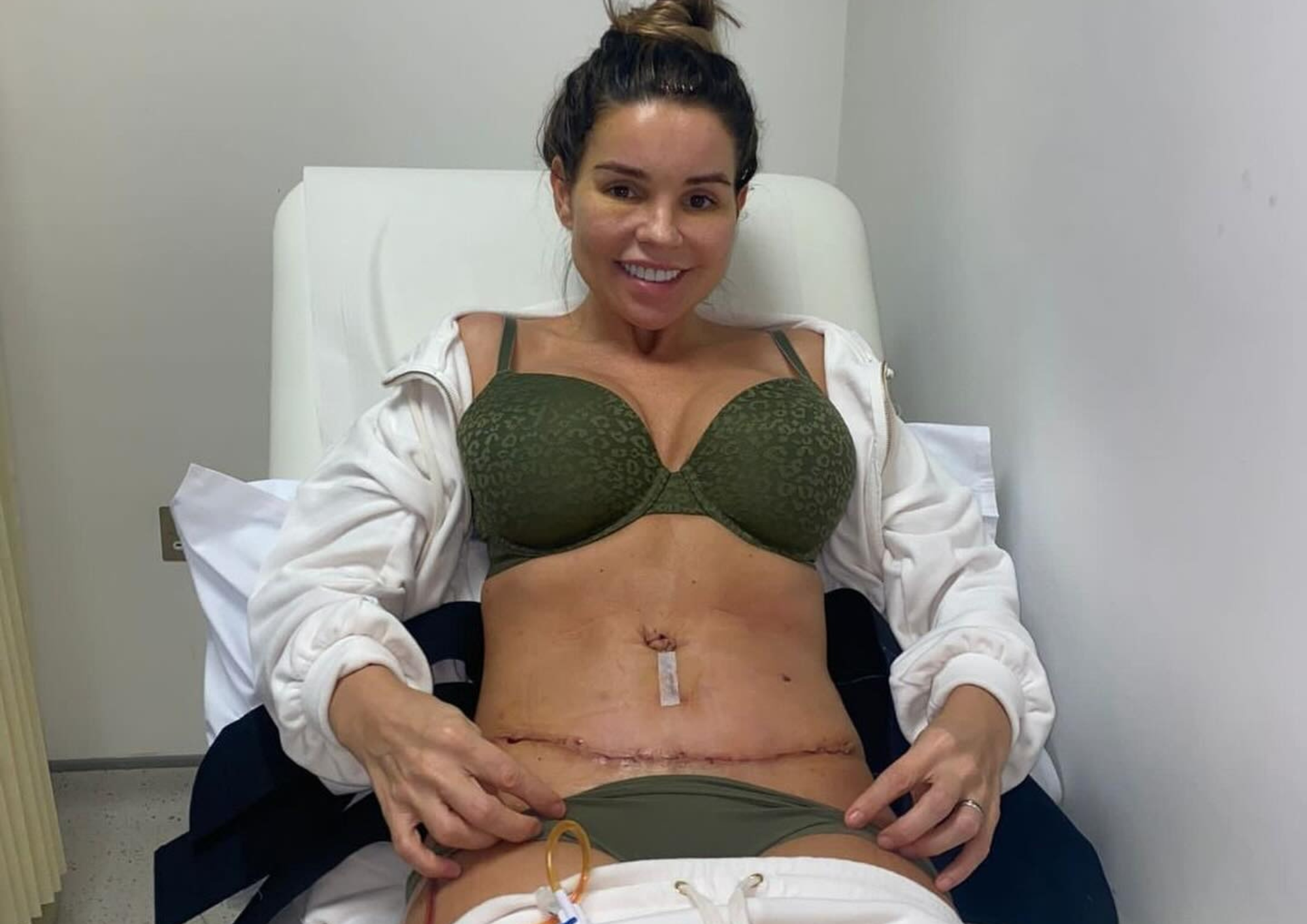 Tanya Bardsley’s Tummy Tuck Scarring