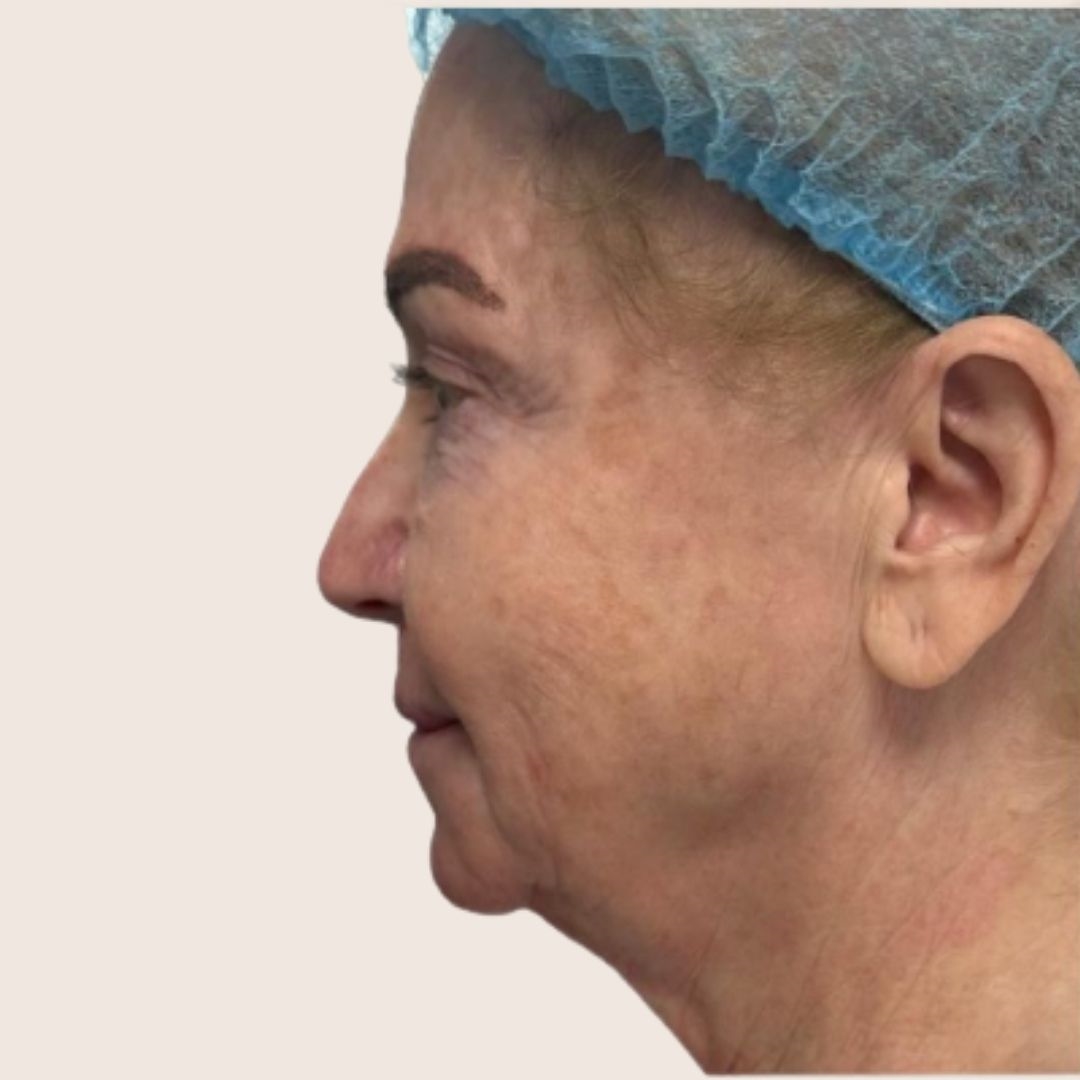 Before neck lift