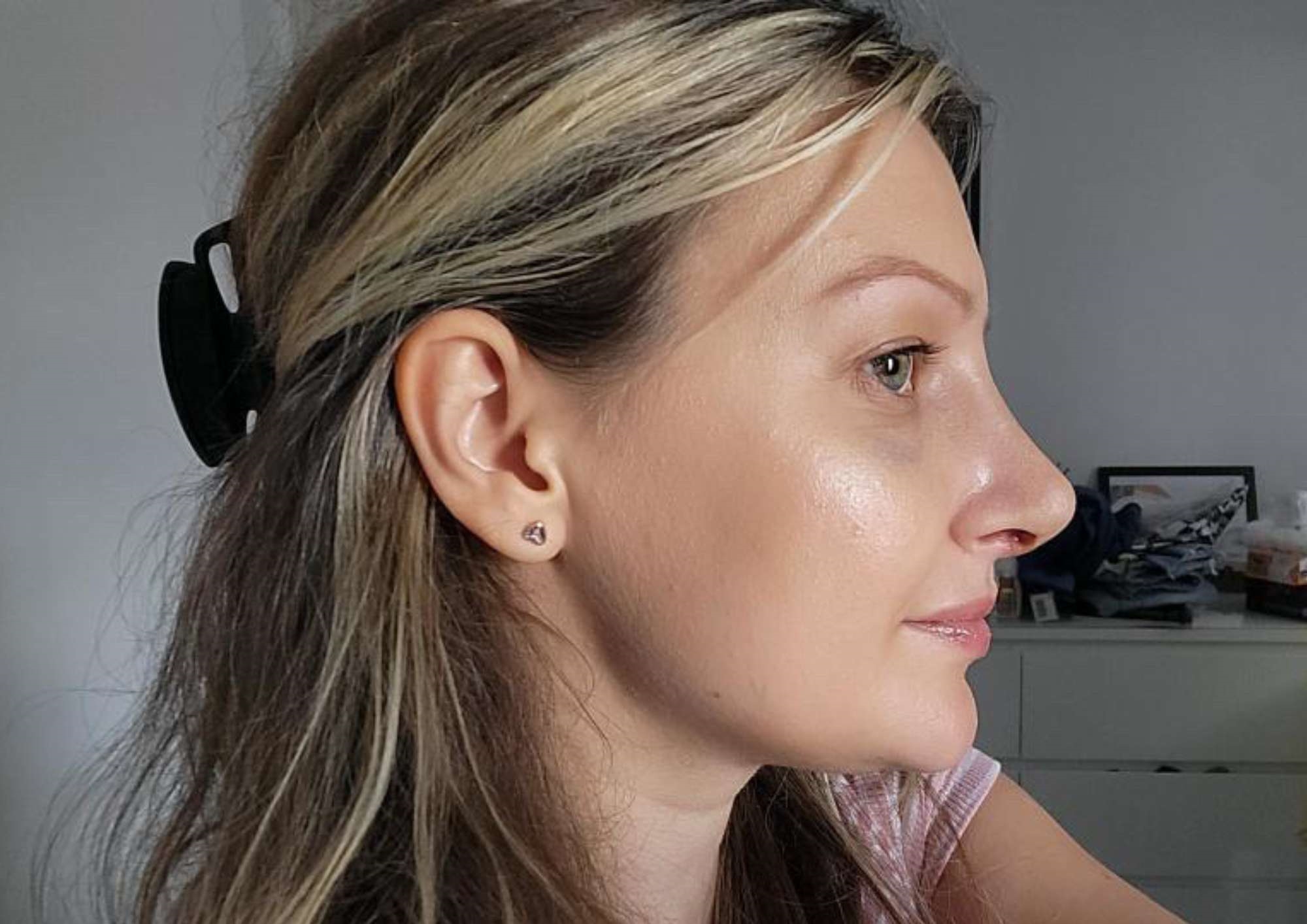 Ewelina's rhinoplasty transformation with Professor Raghavan Ewelina's rhinoplasty transformation with Professor Raghavan