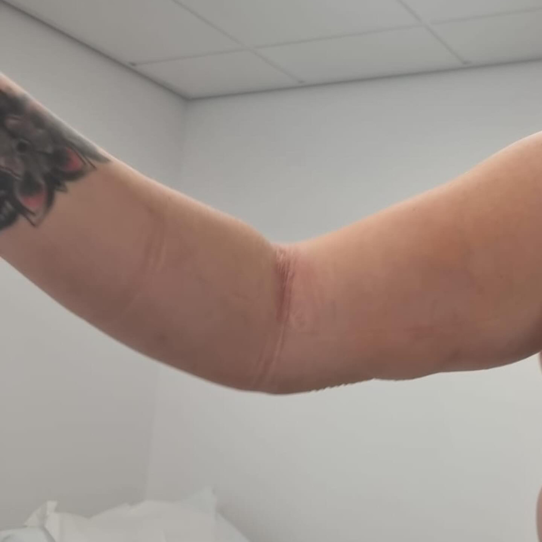 arm lift after arm lift after