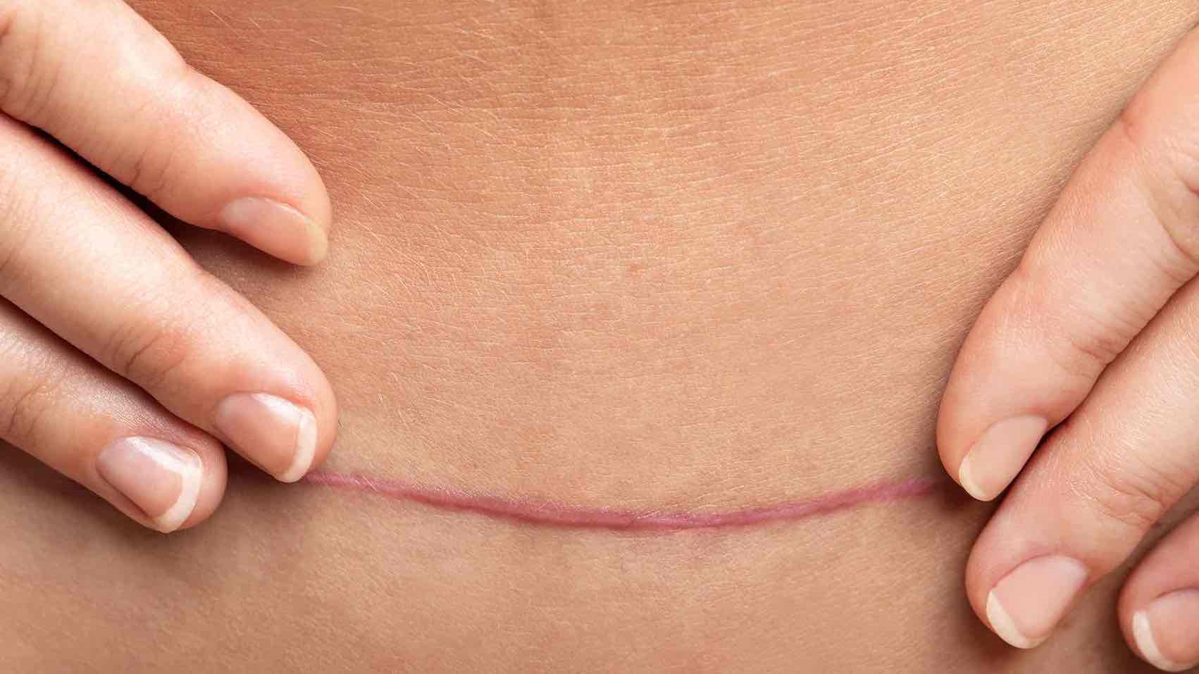 What happens to your belly button during a Tummy Tuck?