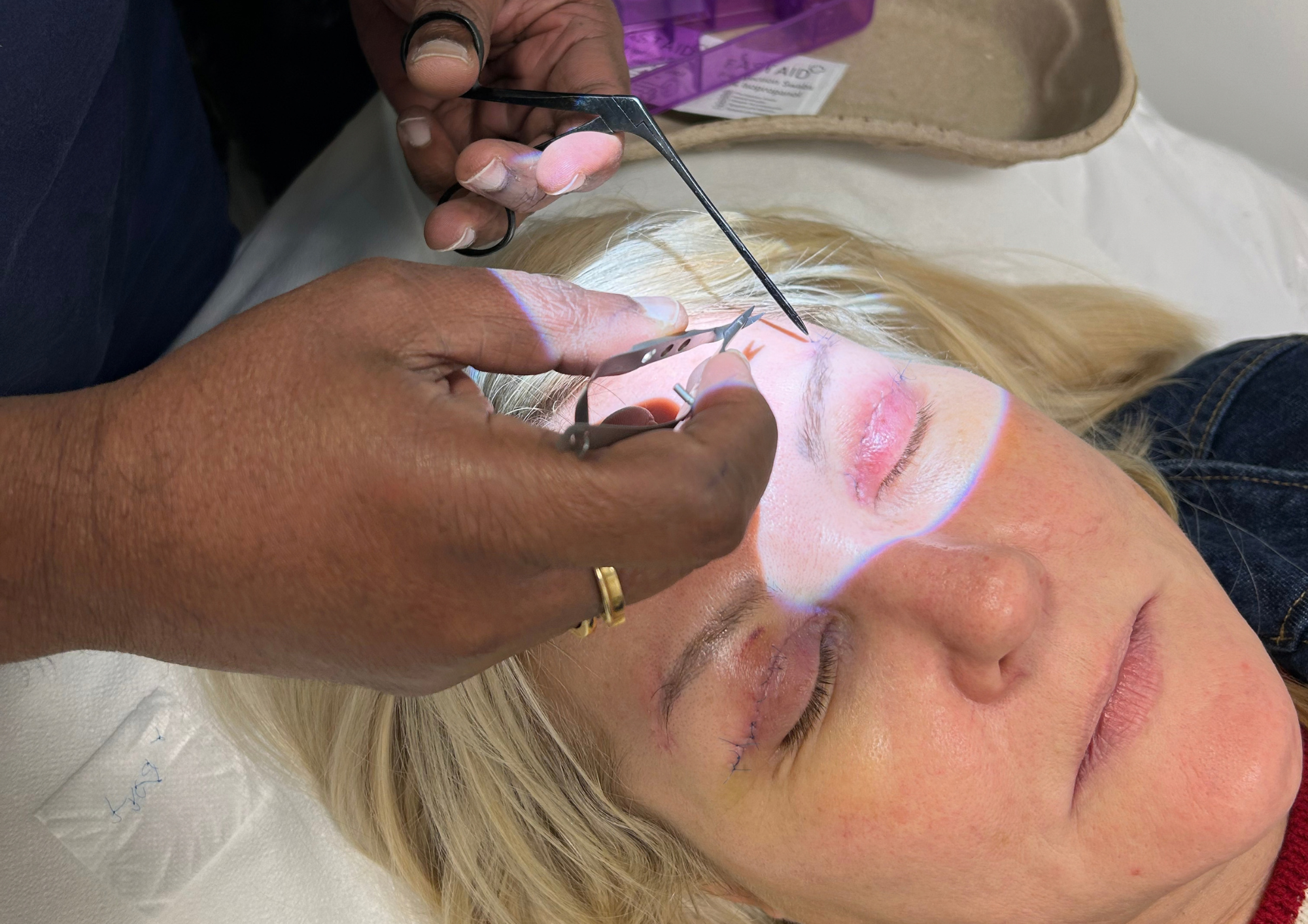 Lisa George Post Surgery Blepharoplasty
