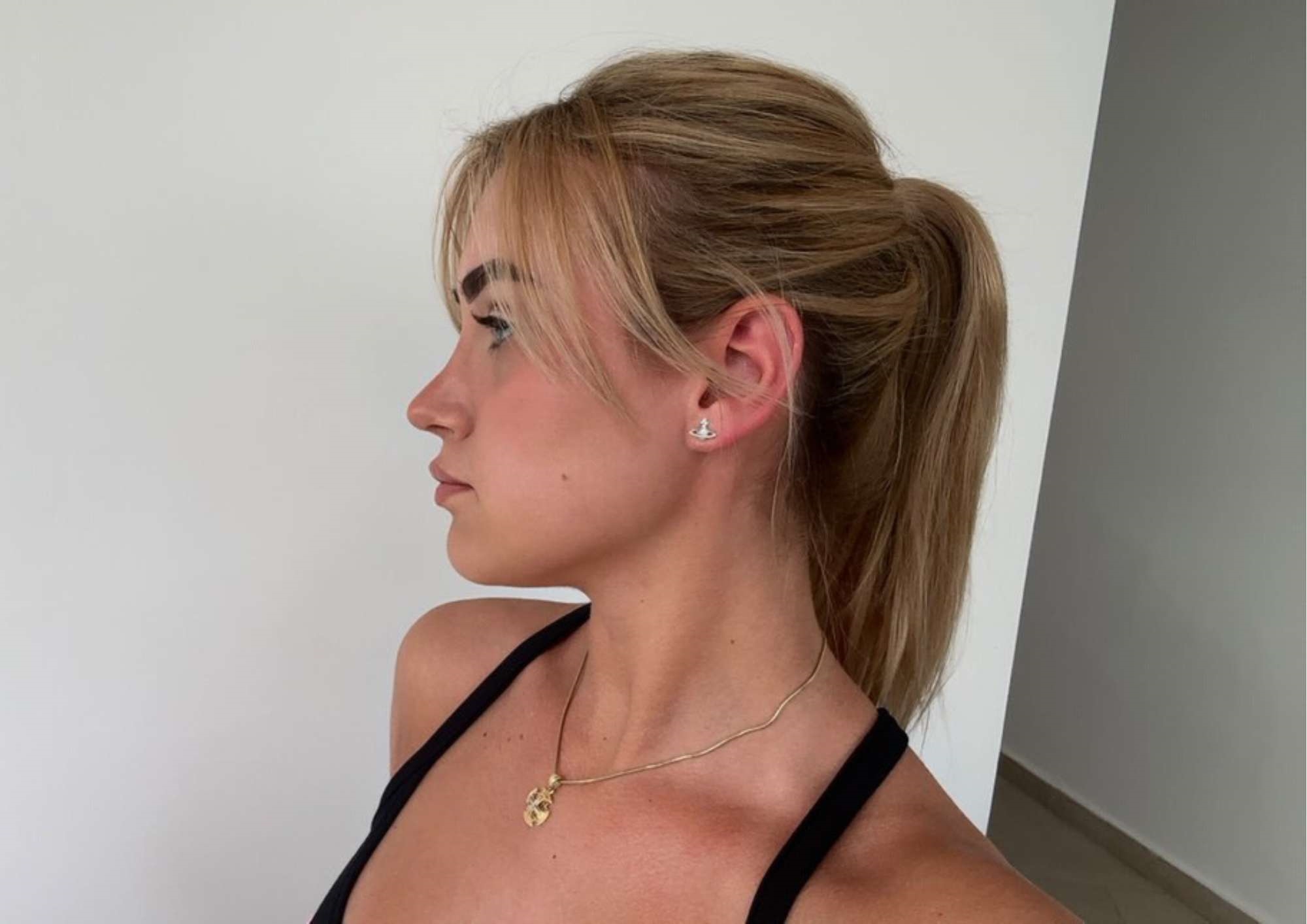 Morgan Lee, Rhinoplasty Patient Morgan Lee, Rhinoplasty Patient