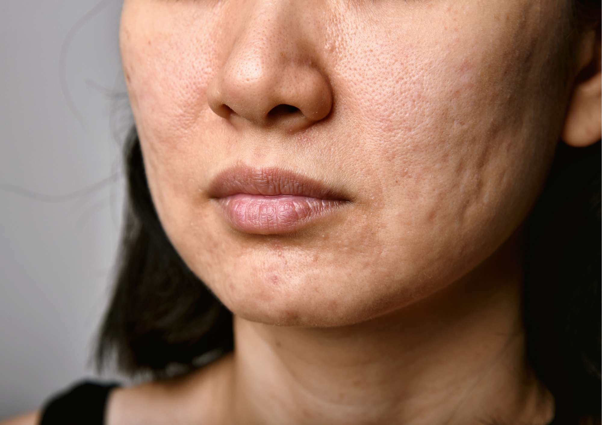 Private Scar Treatment | What causes scarring?