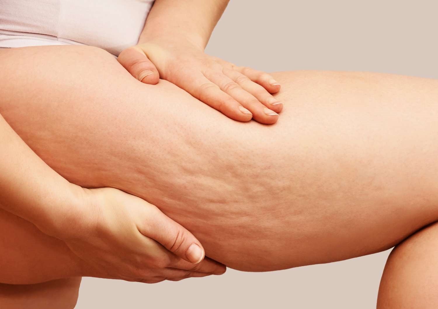 Cellulite on leg - Thighplasty Cellulite on leg - Thighplasty