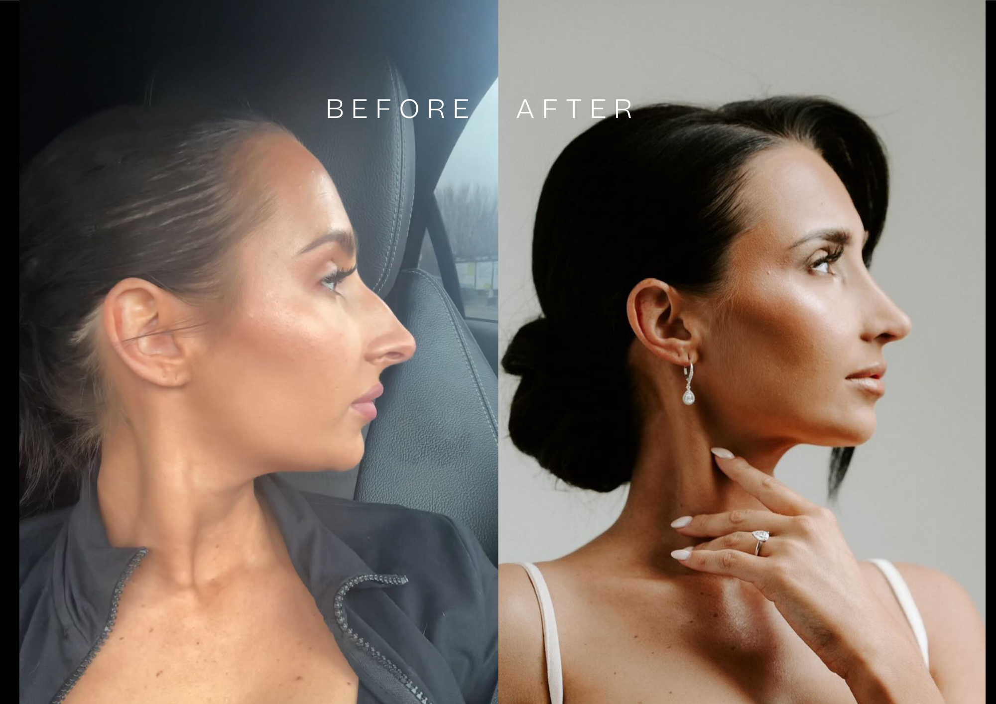 Open rhinoplasty before and after