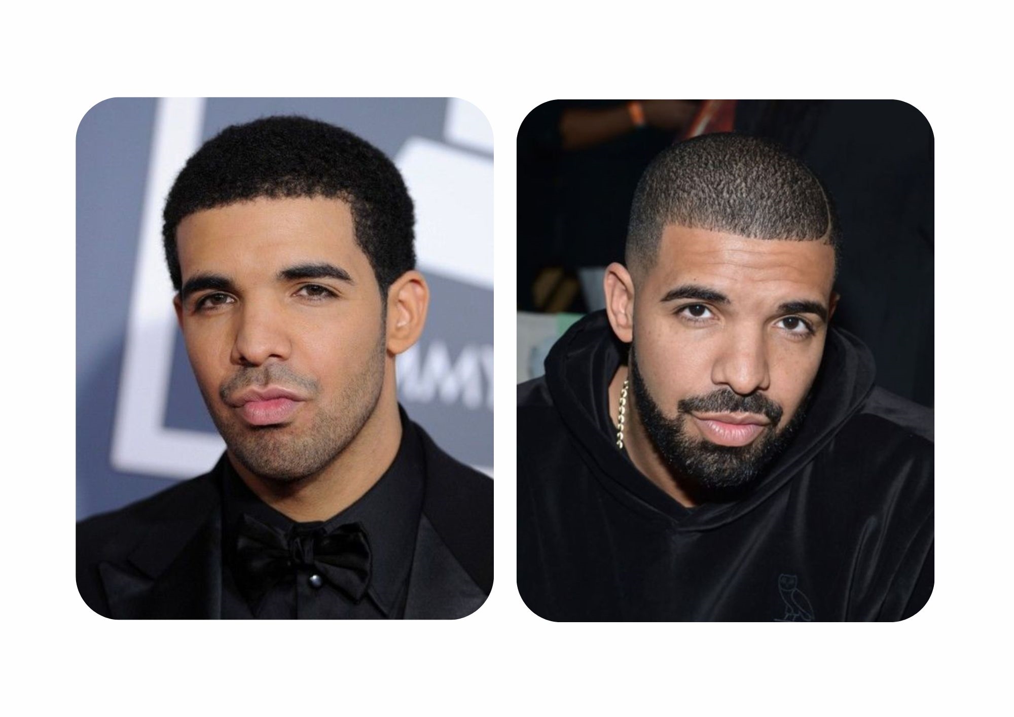 musician Drake nose job before and after pics 