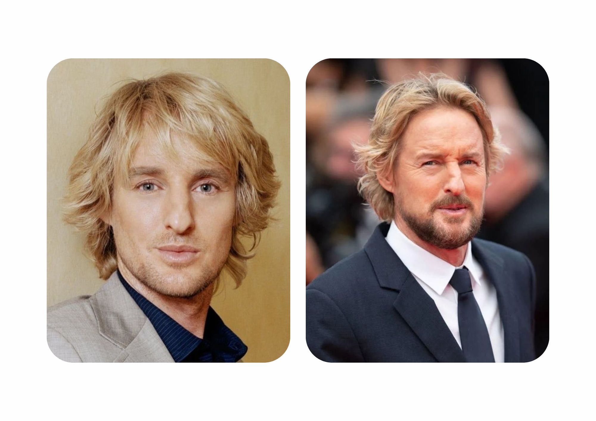 Owen Wilson: nose job before and after 