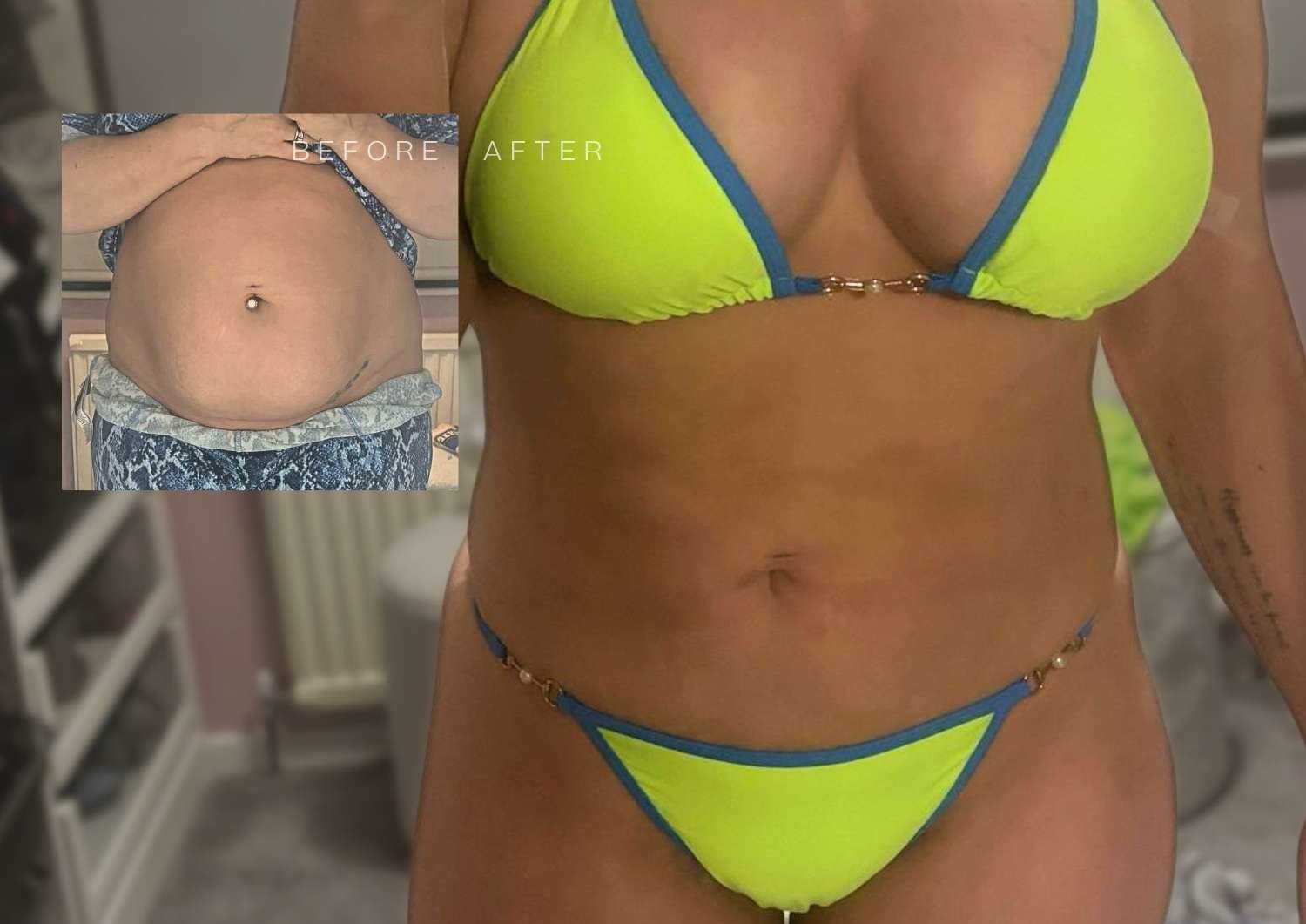 Vaser Liposuction patient Before & After Vaser Liposuction patient Before & After