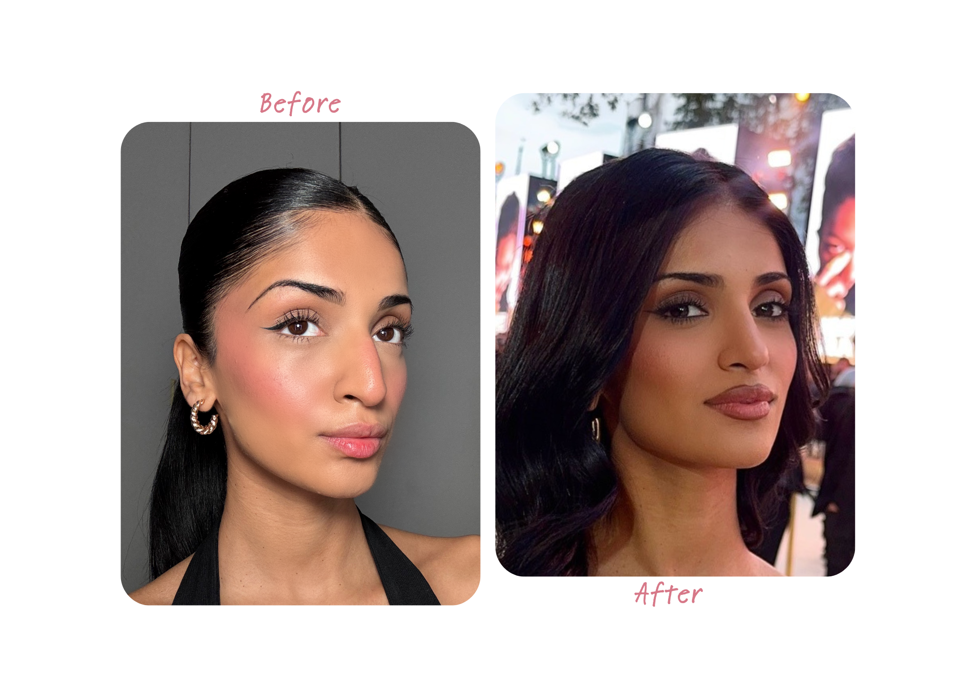 Kim Mann Before & After Rhinoplasty Results Kim Mann Before & After Rhinoplasty Results